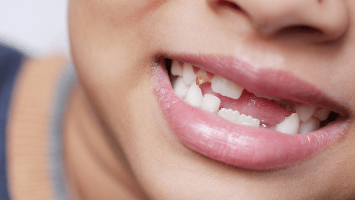child grinning with several front teeth missing