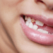 child grinning with several front teeth missing